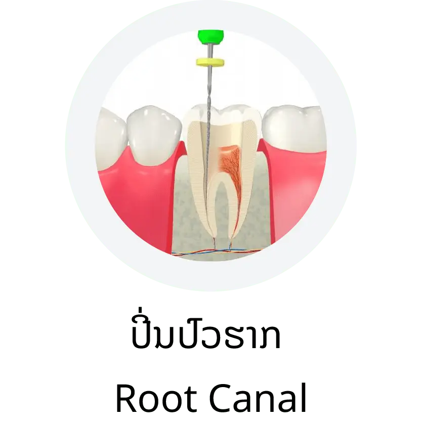 Root Canal (ປີ່ນປົວຮາກ)